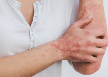 Phototherapy for Psoriasis