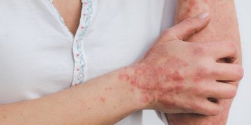 Phototherapy for Psoriasis