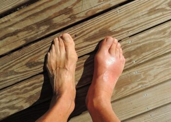 Athlete’s foot facts