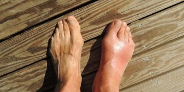 Athlete’s foot facts