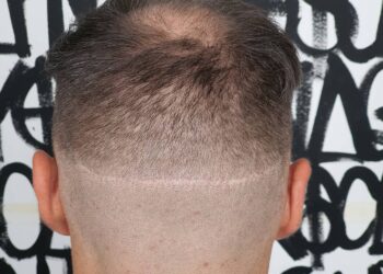 The Benefits of Scalp Micropigmentation in London