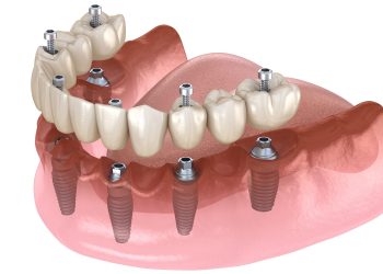Why you Should Consider Getting Dental Implants in Turkey