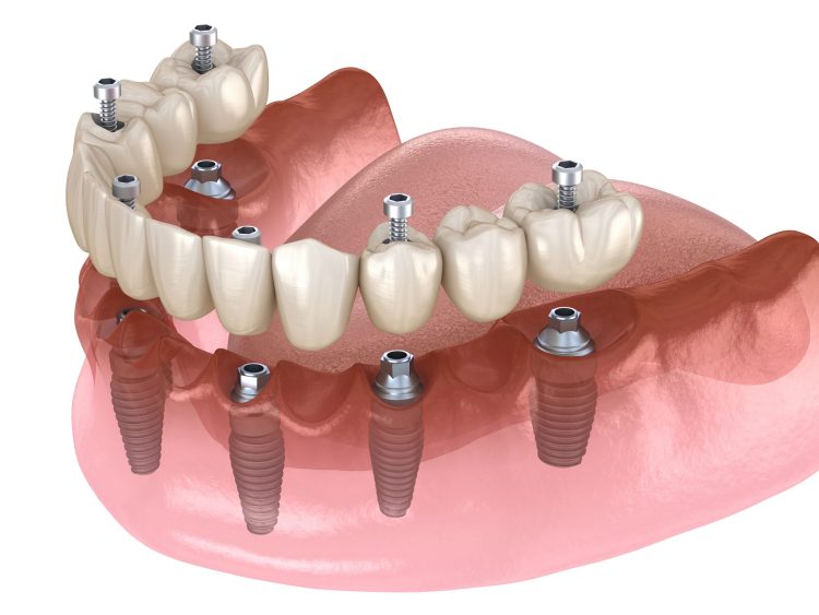 Why you Should Consider Getting Dental Implants in Turkey