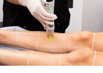 The Top 5 Benefits of Laser Hair Removal for People with PCOS