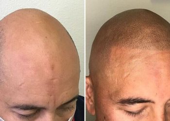The Maintenance of Scalp Micropigmentation