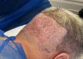 Hair Transplant Cost in Turkey: Affordability and Quality