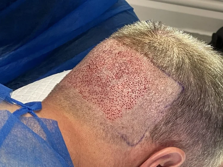 Hair Transplant Cost in Turkey: Affordability and Quality