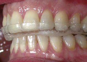 Michigan Occlusal Splints: The Benefits of This Popular Treatment for Temporomandibular Disorders (TMD)