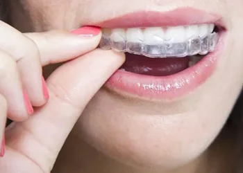A Comprehensive Guide to the Reasons for Getting Invisalign Braces in Essex