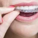 A Comprehensive Guide to the Reasons for Getting Invisalign Braces in Essex