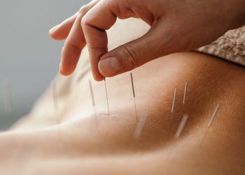 Beyond Needles and Stereotypes: Unveiling the Benefits of Finding the Best Acupuncture London