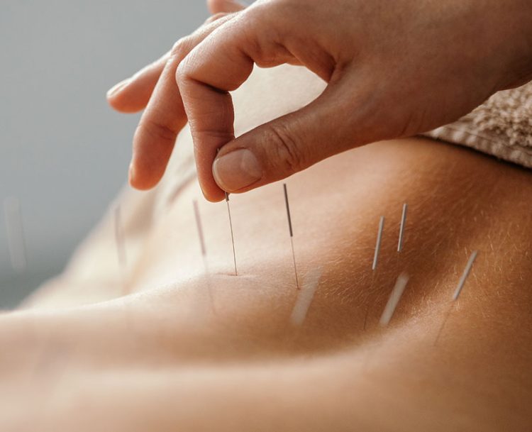 Beyond Needles and Stereotypes: Unveiling the Benefits of Finding the Best Acupuncture London