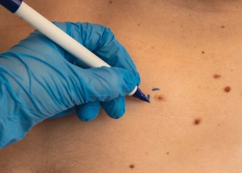 Ensuring Safe and Effective Skin Tag Removal in Birmingham