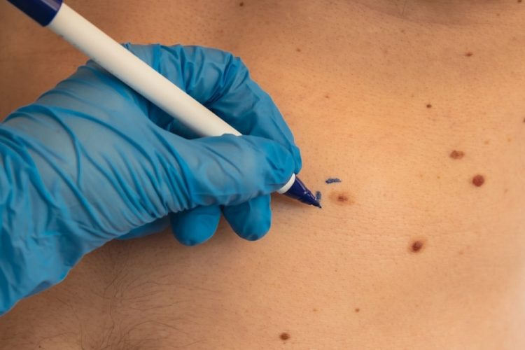 Ensuring Safe and Effective Skin Tag Removal in Birmingham